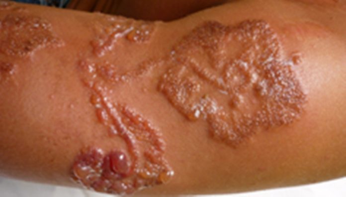 L’allergie