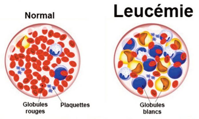ÂLLO DOCTEUR ! La leucémie chez l’enfant