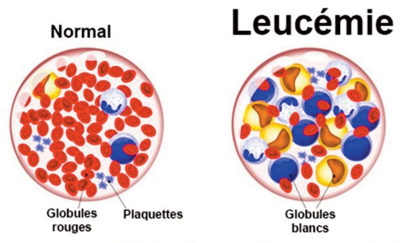 ÂLLO DOCTEUR ! La leucémie chez l’enfant