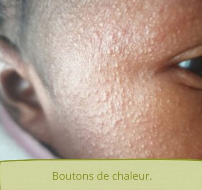 Chaleur et humidité la bourbouille une affection cutanée qui touche de nombreux Djiboutiens (1)